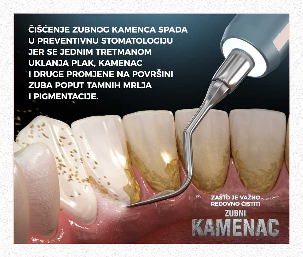 Ciscenje zubnog kamenca